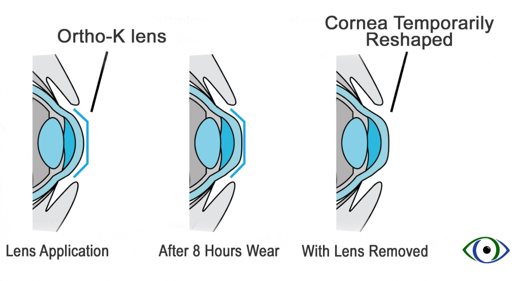 Corneal Refractive Therapy