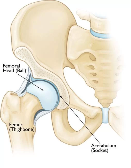 Perthes Disease