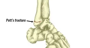 Potts fracture