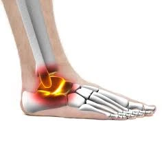 Sinus tarsi syndrome