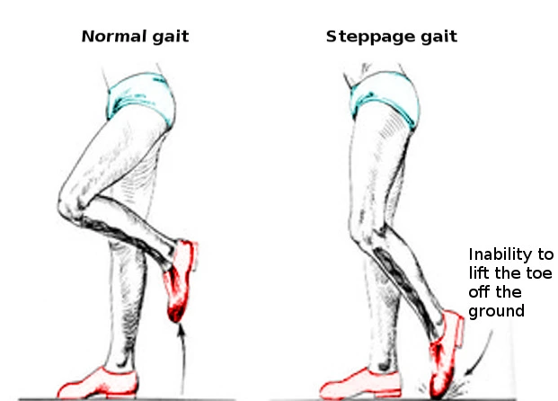 Steppage Gait