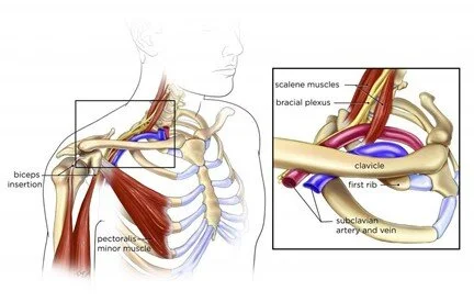 costoclavicular syndrome