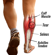 muscle tear in calf