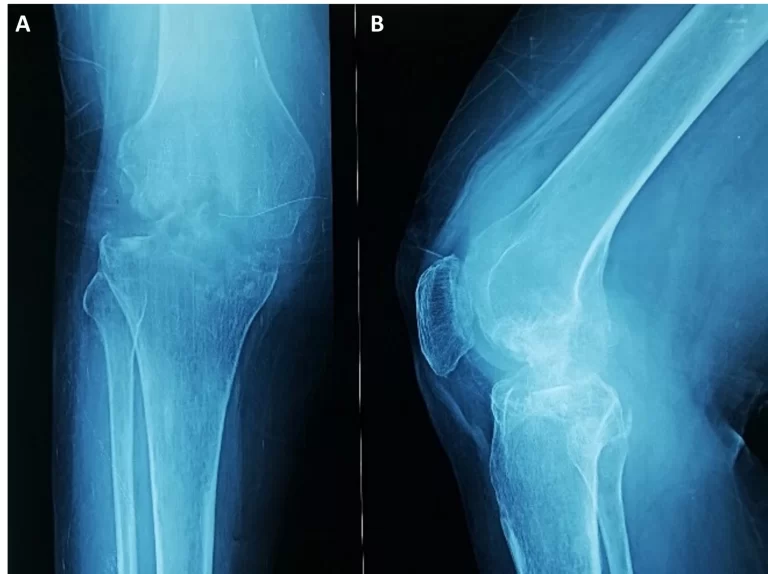 Tuberculous Arthritis