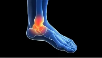 Ankle Joint Stiffness