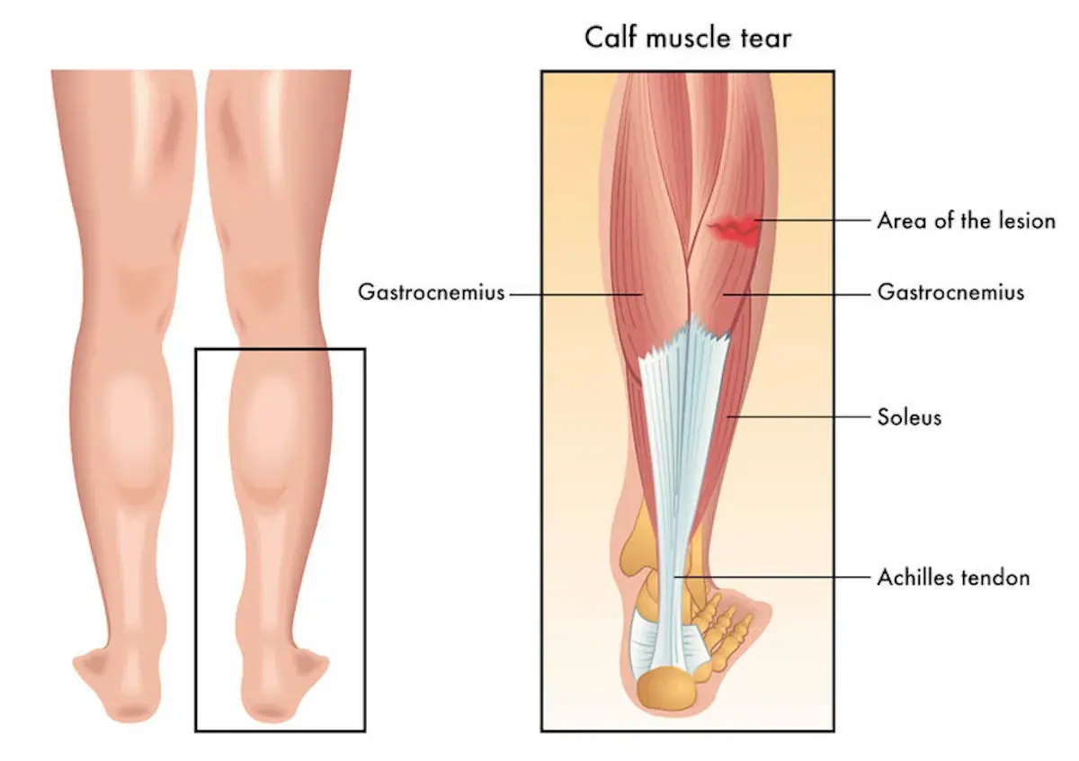 Calf Strain