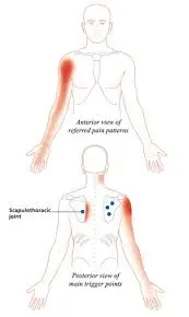 Infraspinatus Muscle Pain