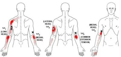 Trigger Points in Triceps Muscle