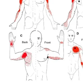 Trigger points in biceps muscle