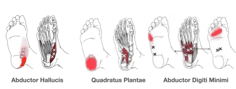 Trigger points in foot muscle