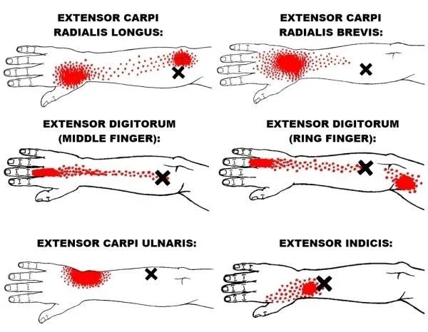 Trigger points in forearm muscle