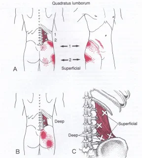 Trigger points in lower back