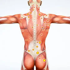 Trigger points treatment