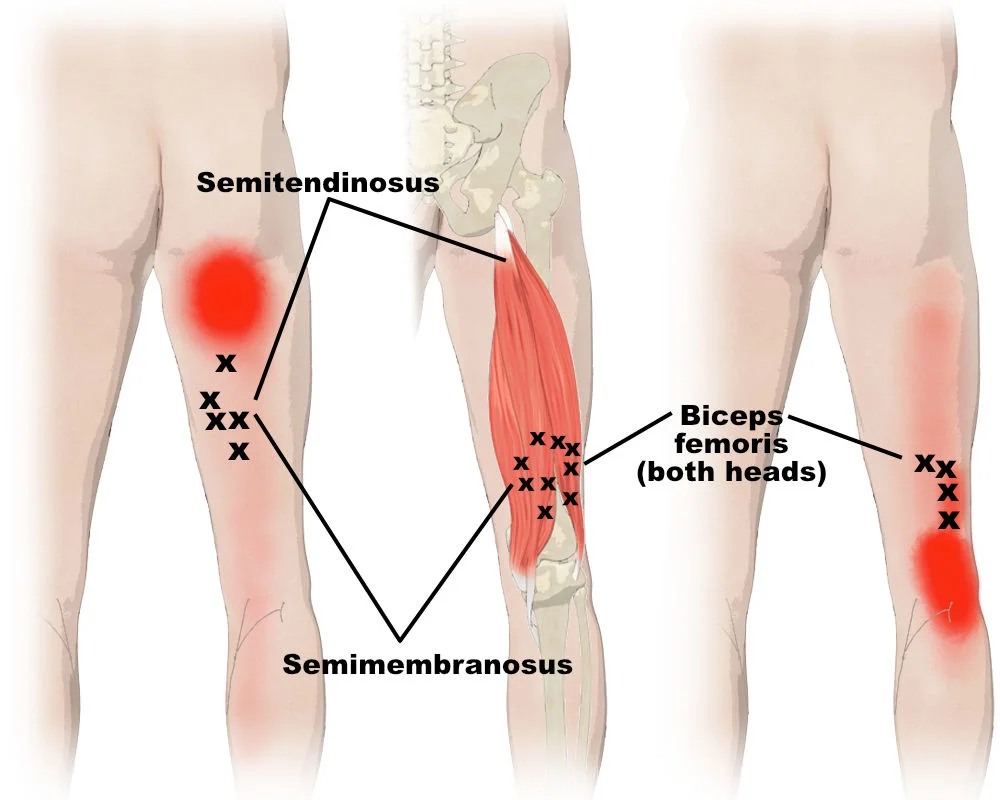 hamstring trigger point