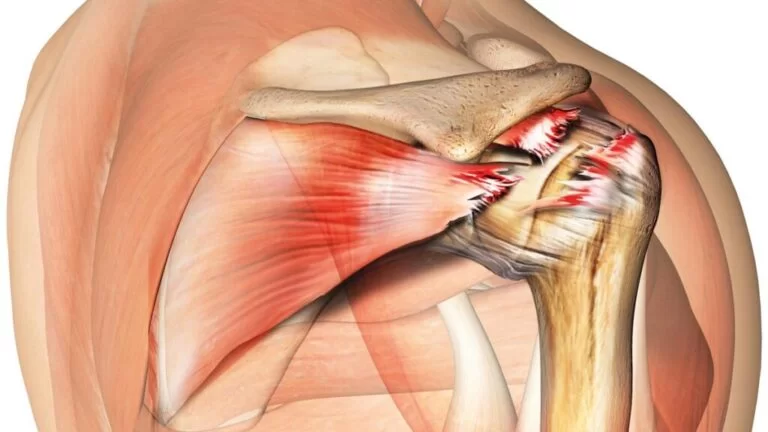 Infraspinatus Tendon Tear