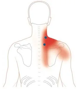 levator Scapulae Muscle Pain