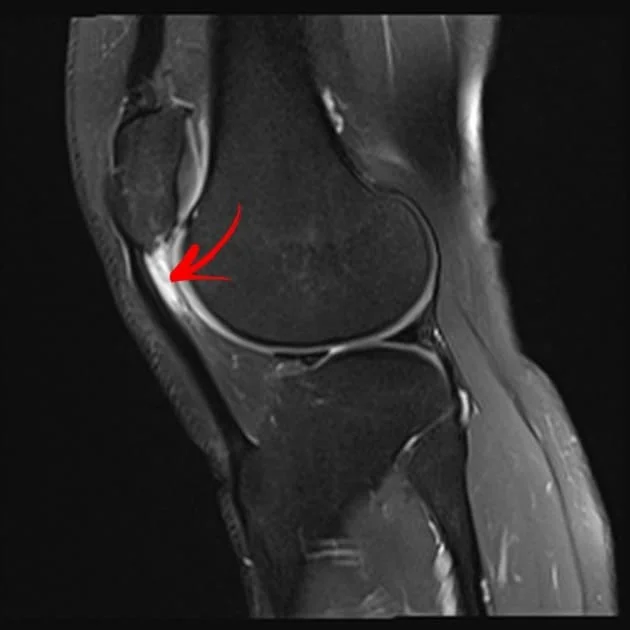 patellar tendon-lateral femoral condyle friction syndrome