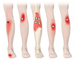 trigger points in calf muscle