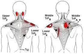 Trigger Points in Trapezius Muscle