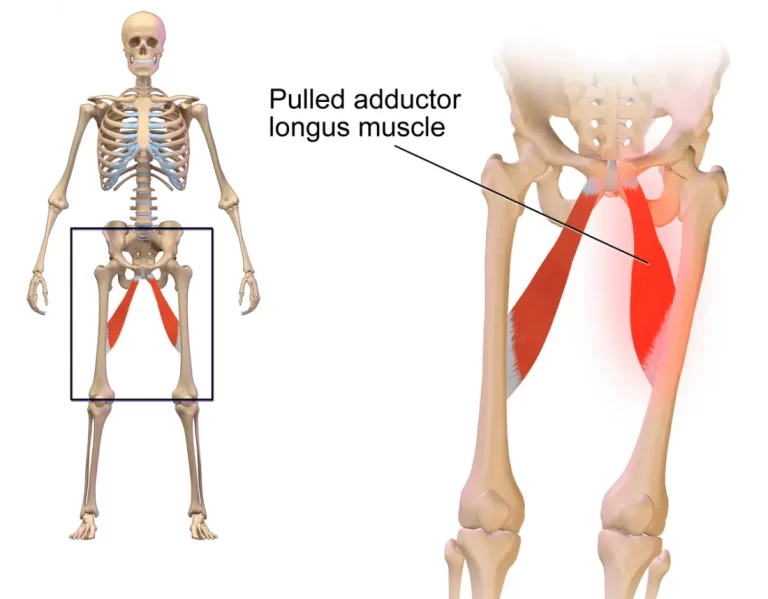 Groin Strain