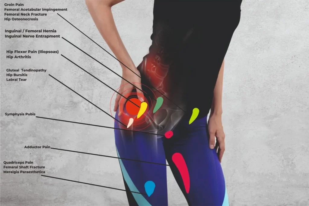 Hip Pain Location Diagram