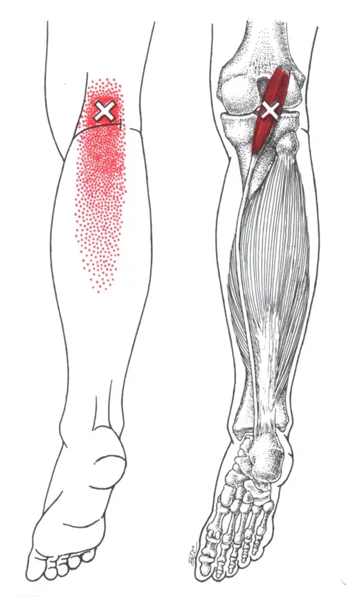 Plantaris Muscle Pain