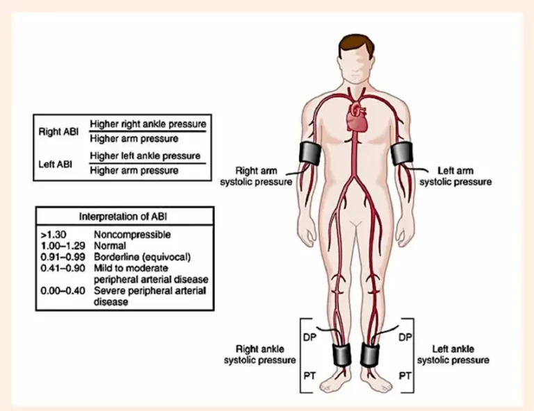 Ankle-Brachial Index