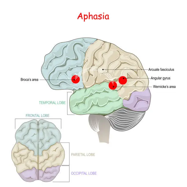 Aphasia