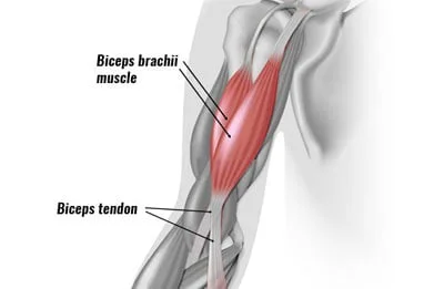 Biceps Tendonitis