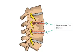 Cervical Degenerative Disc Disease