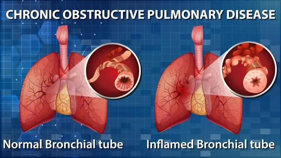 Chronic Obstructive Pulmonary Diseases