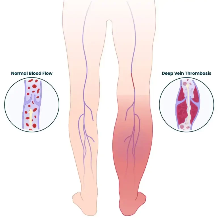 Deep vein thrombosis