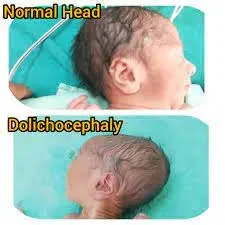 Dolichocyphaly