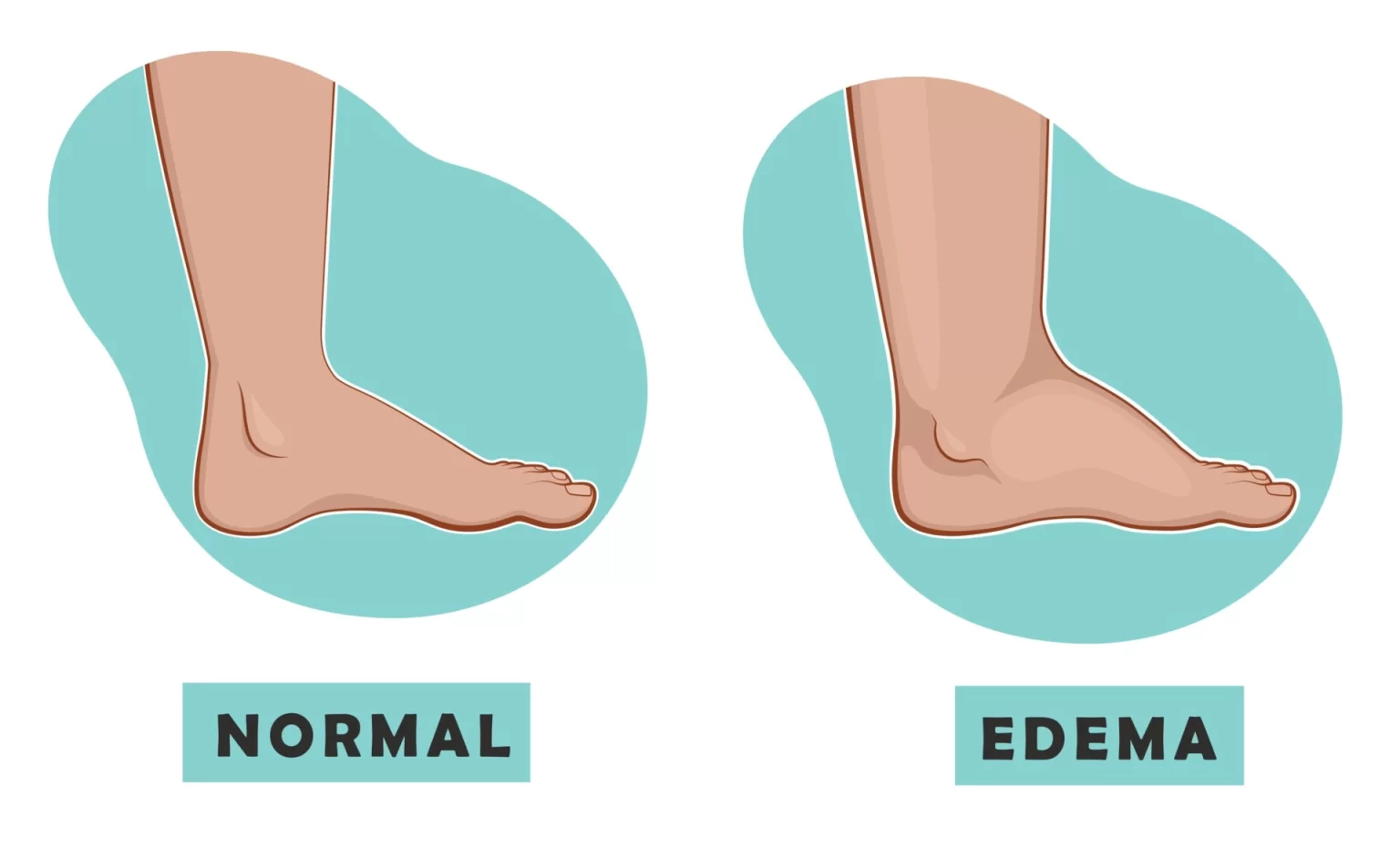 Edema