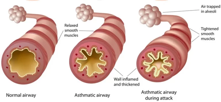 Exercise-induced Asthma