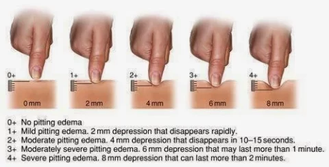 Grades of edema