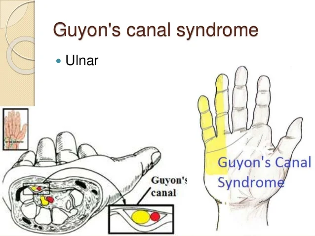 Guyon Canal Syndrome