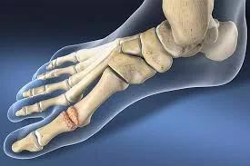 Hallux Rigidus