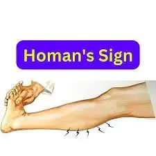 Homan sign