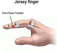 Jersey's finger