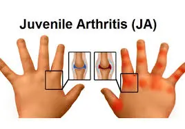 Juvenile arthritis