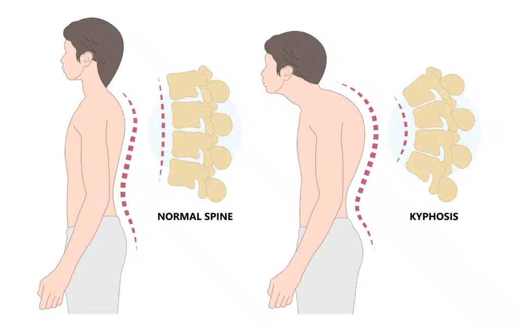 Kyphosis