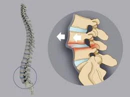 Lumbar instability