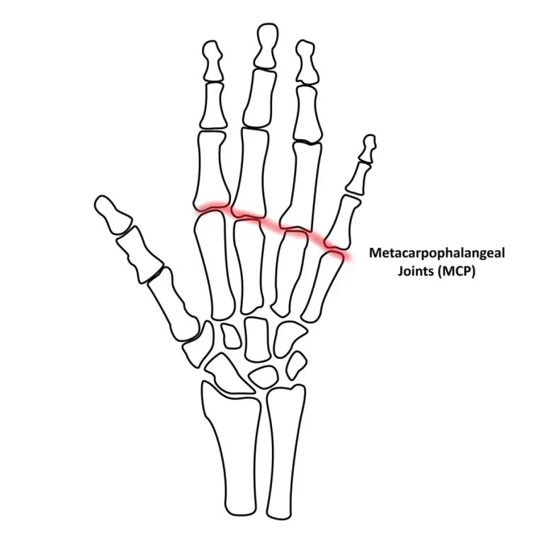 Metacarpophalangeal (MCP) Joints