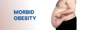 Read more about the article Morbid Obesity