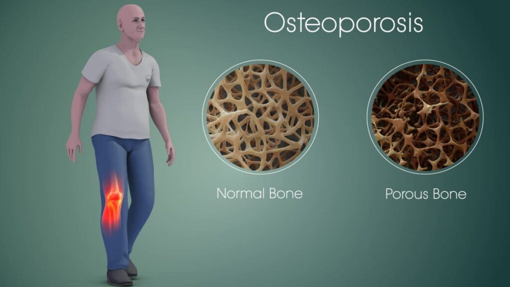 Chondromalacia Patella (CMP) - Cause, Symptoms, Treatment