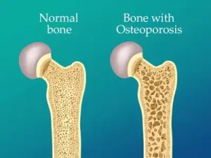 Osteoporosis bone