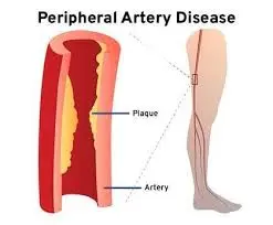 Peripheral artery diseases