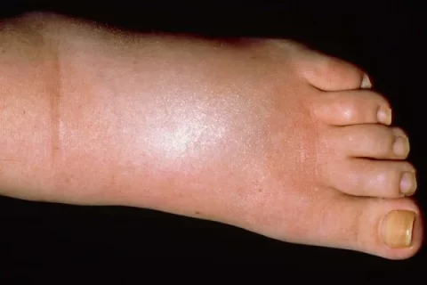 non-pitting edema