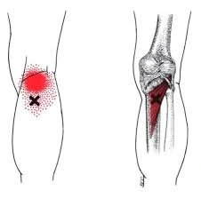 Popliteus Muscle Pain